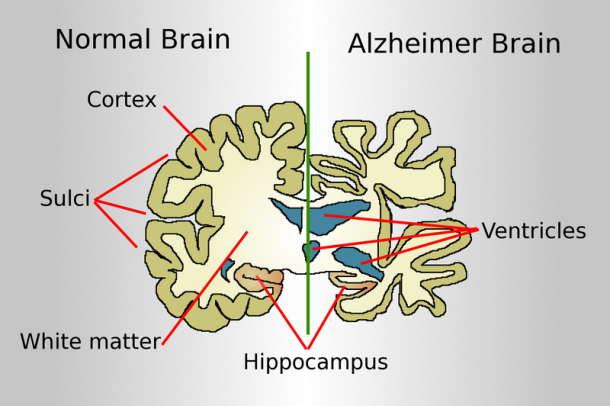 A normális és az alzheimer-es agy
Forrás: commons.wikimedia.org