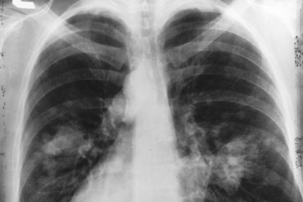 Tüdőröntgenen látható a tüdőrák
Forrás: upload.wikimedia.org