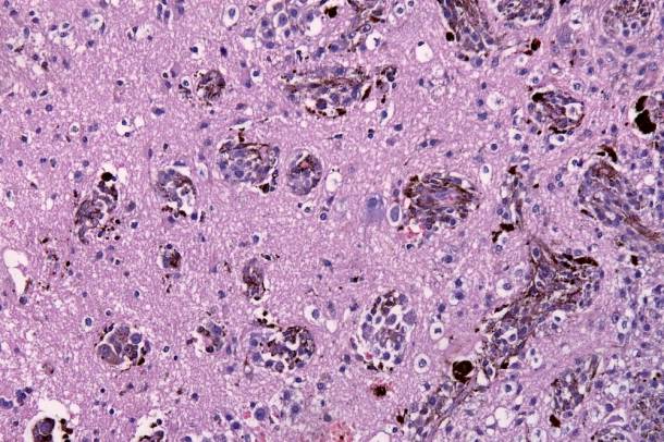 Melanoma sejtek agyi beszűrődése
Forrás: commons.wikimedia.org