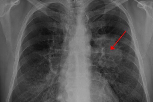 Tűdőrák röntgen
Forrás: wikipedia.org