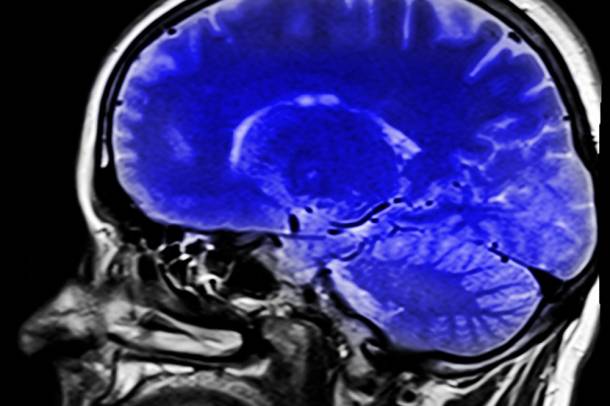 Emberi agy mágneses rezonancia képalkotó eljárással (MRI)
Forrás: pixabay.com
