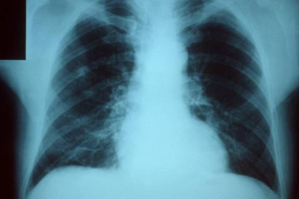 Tüdő röntgenfelvétel
Forrás: commons.wikimedia.org