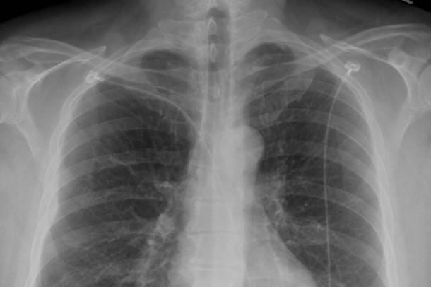 Tüdőröntgen (Képünk illusztráció!)
Forrás: commons.wikimedia.org
Szerző: O'Dea
