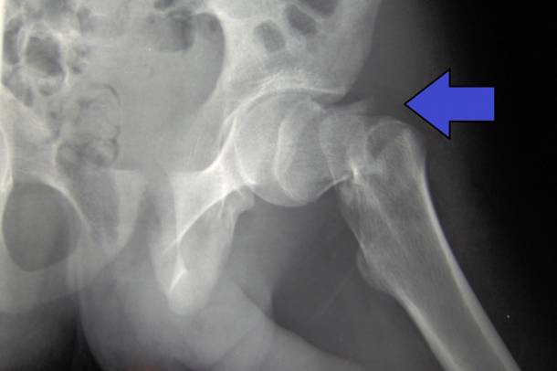 Csípőtörésről készült röntgen - illusztráció
Forrás: commons.wikimedia.org