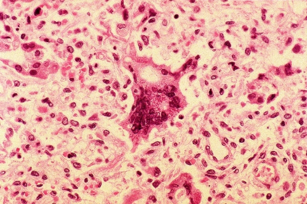 Kanyaróhoz társuló tüdőgyulladásban megjelenő óriássejtek finomszöveti metszeten
Forrás: Wikipedia